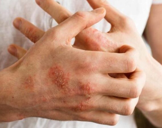 Dead Sea Salt Eczema – Natural Home Treatment and Remedy For Eczema