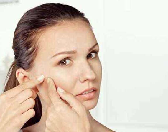 Homeopathic Acne Treatment – Can You Eradicate Acne With It?