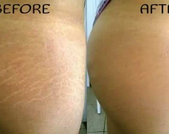 Do Stretch Marks Ever Really Disappear?