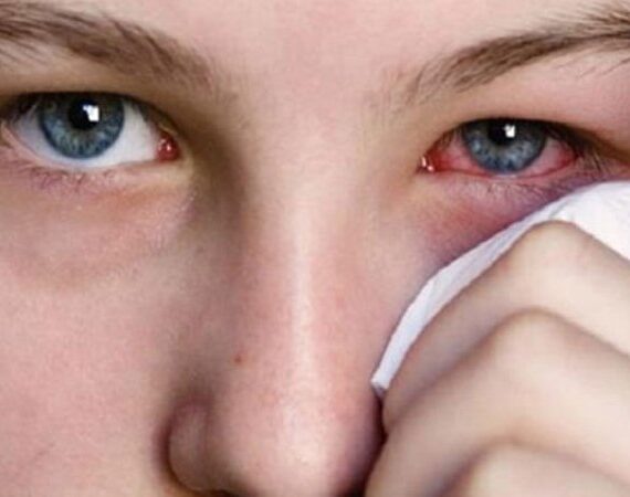 Pink Eye Symptoms And Your Health